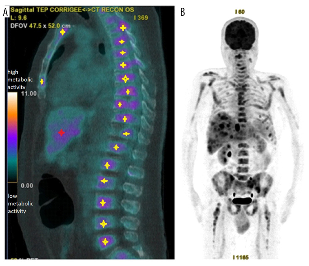 Sagittal (A) and coronal (B) PET scan overall views showing initial multiple metastatic locations including liver nodules (red cross) and vertebral lytic lesions (yellow crosses).