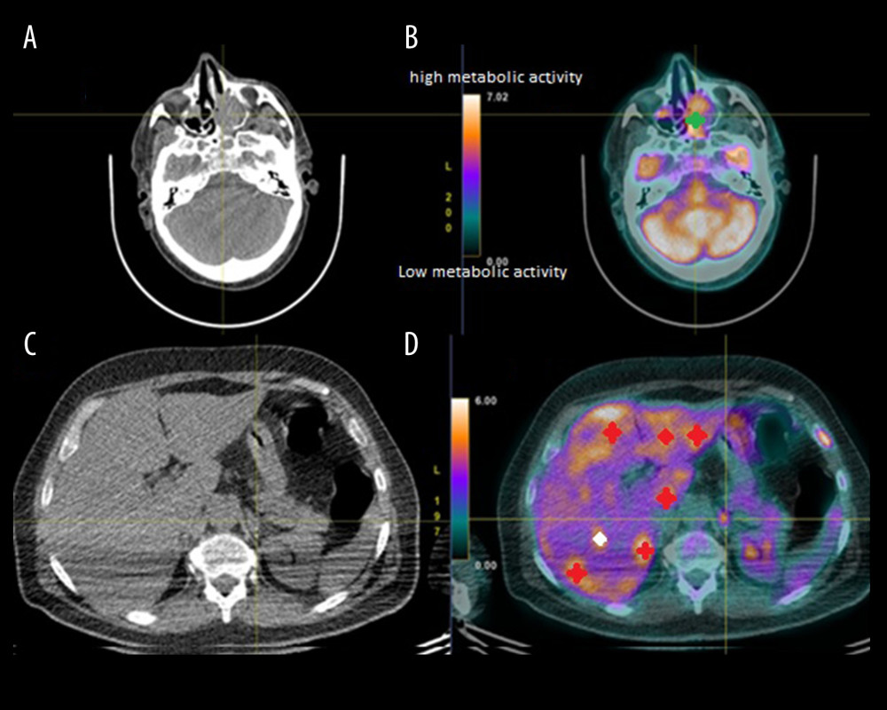 Axial PET scan view of head with primary tumor (A, B) and metastatic liver (C, D) showing both heterogeneous liver nodules with compression of the inferior vena cava (red crosses) and primary hypermetabolic lesion of left ethmoidal bone (green cross).