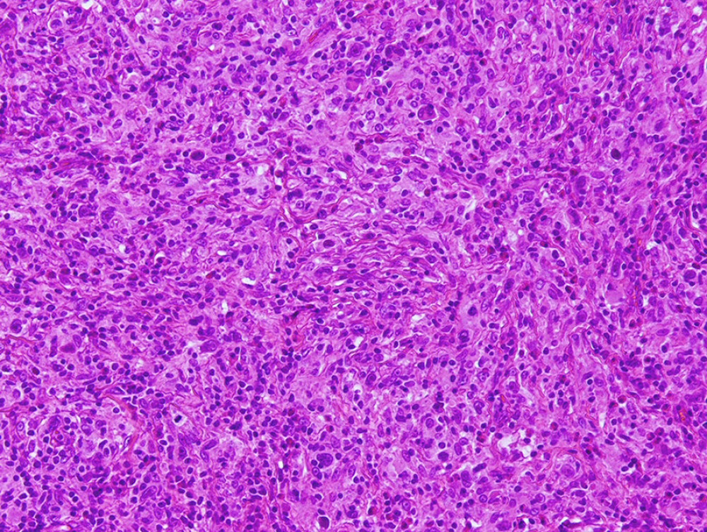 H&E staining, mixed heterogeneous infiltrate that contains pleomorphic large cells.