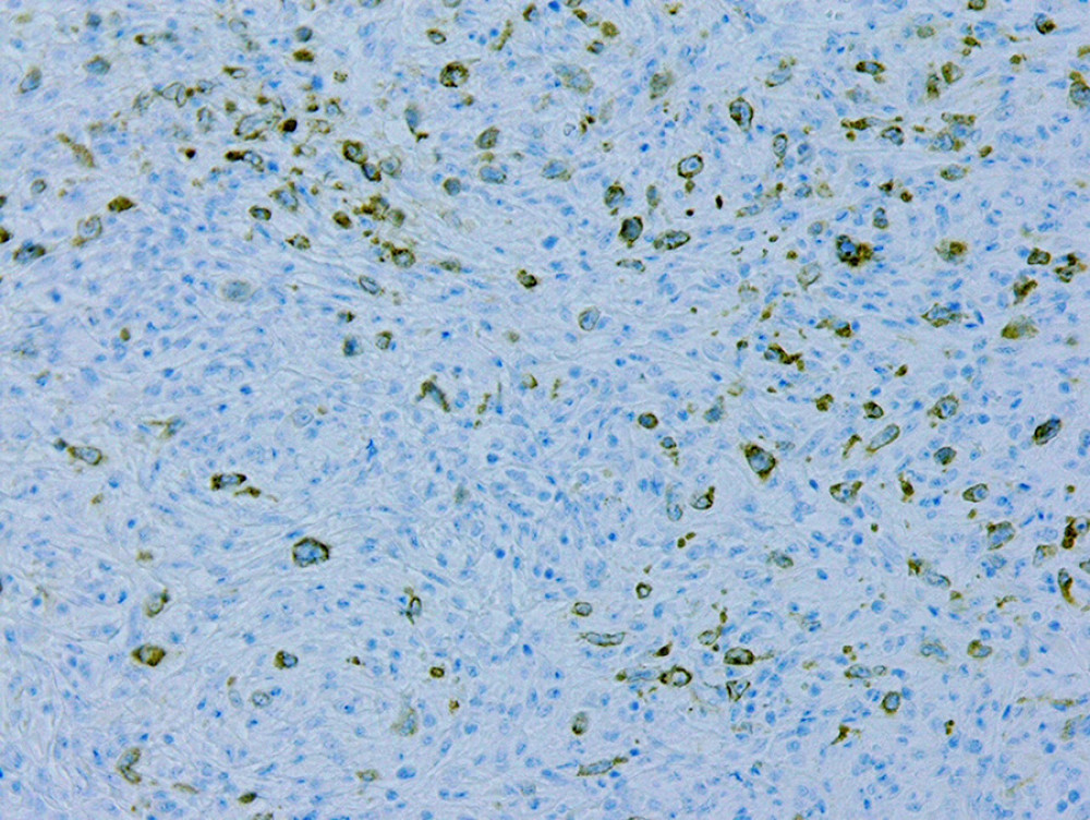 CD30, Hodgkin/Reed-Sternberg cells.
