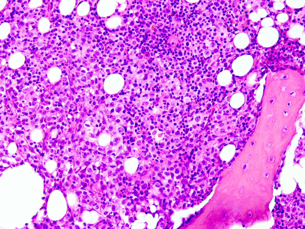 H&E staining, overview of the infiltrate and adjacent residual hemopoiesis.