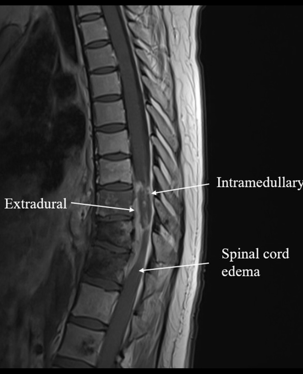 First spine MRI with contrast, T1 sequence sagittal. Distribution of metastases in a length of approximately 3.7 cm extradurally, intradurally, and intramedullary, causing spinal cord edema and compression.