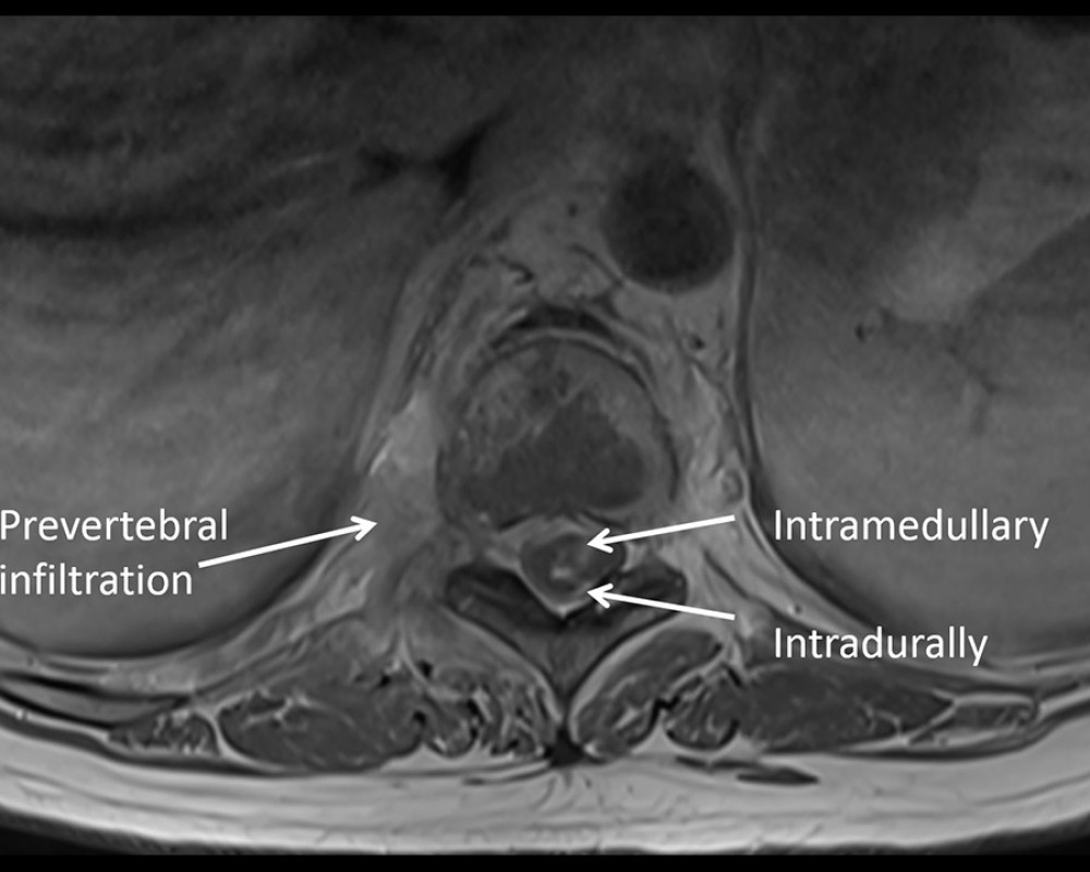First spine MRI with contrast, T1 sequence axial. Prevertebral pathological tissues and abnormal infiltration in the spinal canal at the same level were observed, localizing more in the anterior parts and laterally to the left, with visible compression of the spinal cord.