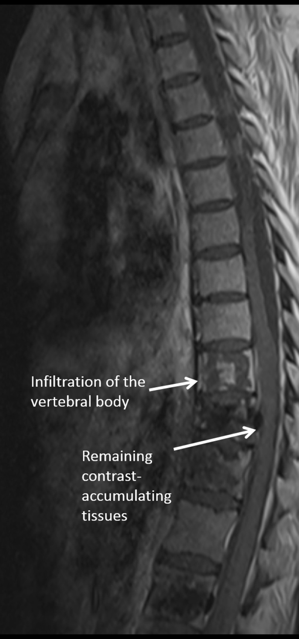 Second spine MRI with contrast, T1 sequence sagittal. It is seen that pathological tissues remain and do not cause cerebral edema and spinal cord compression.