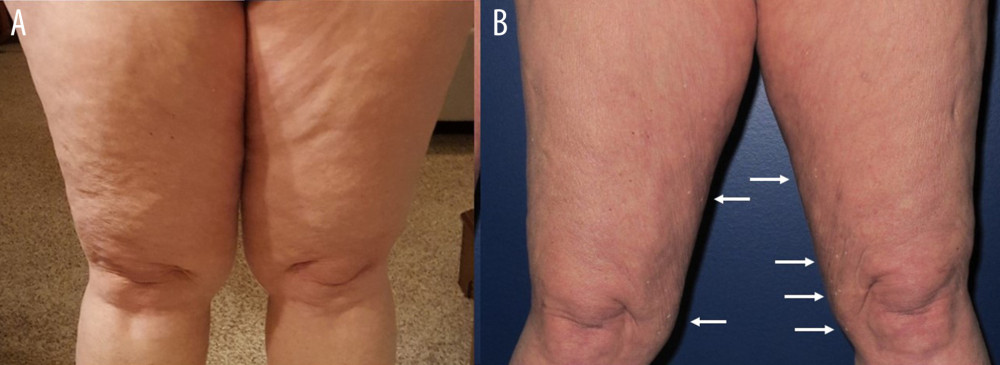 Case 1 legs before (A) and after (B) suction lipectomy. The left side of the photo shows subcutaneous hypertrophy is visible in a column shape on the front of the thighs and slightly overhanging the knees prior to suction lipectomy. Right side of the photo shows thighs 6 months after surgery with arrows pointing to verrucous skin changes indicative of lymphedema.