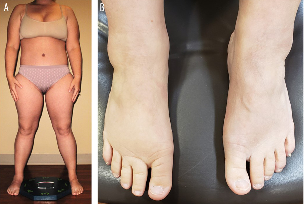 ARE FAT LEGS AT PUBERTY AN EARLY SIGN OF LIPEDEMA? - Total Lipedema Care