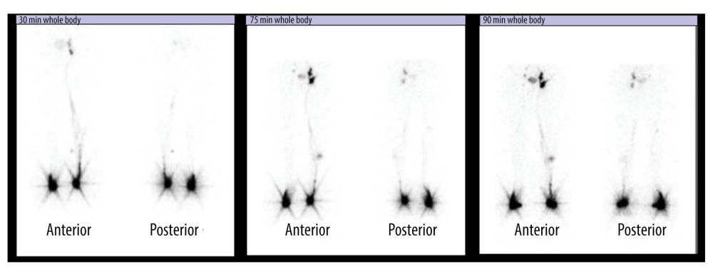 Case 2 lymphoscintigram performed 6 months post operatively suction lipectomy. Whole-body lymphoscintigram images at 30, 75, and 90 min after radiolabeled colloid is injected. Anterior and posterior images are displayed. Lymphatic flow and lymphatic vessels are visualized on the left leg. The right leg shows a mild dermal back flow and no flow, vessels or inguinal uptake of Technetium in the right inguinal nodes consistent with lymphatic obstruction.