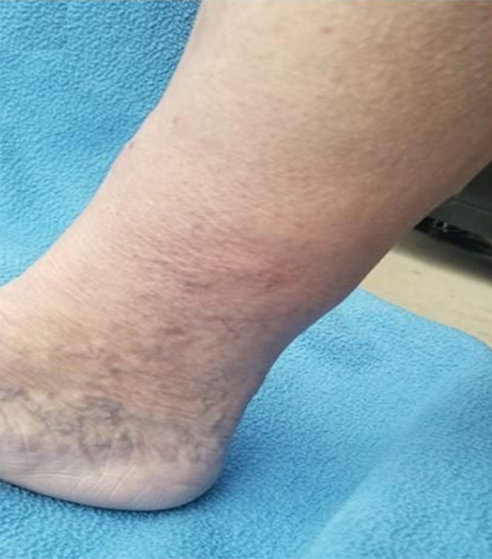 Close-up of left lateral ankle and lower leg of Case 3. Notice the slight erythema, hyperkeratosis, and papillomatosis of the skin. Swelling is evident with loss of landmarks of the lateral malleolus. Note the venous telangiectasias on the foot, which also developed after the suction lipectomy.