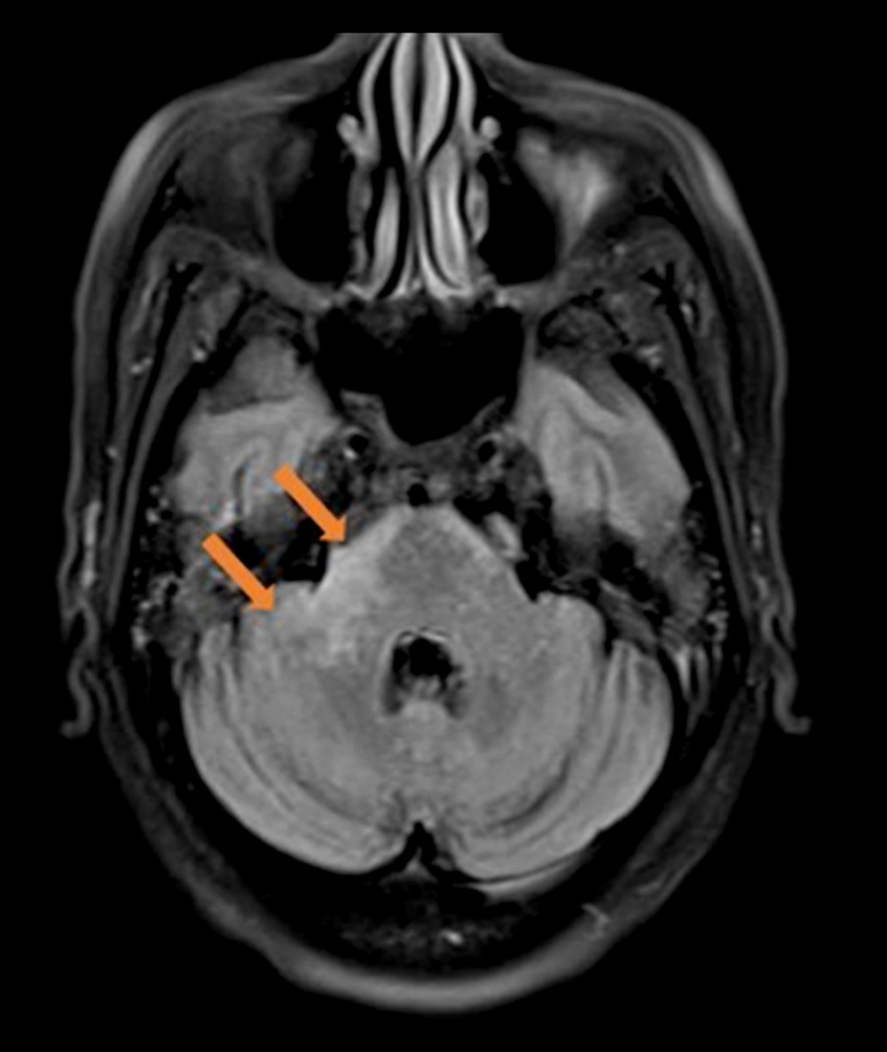 Brain magnetic resonance imaging (MRI) on the first hospital admission revealed non-enhancing T2-weighted hyperintensities in the right lateral pons and right brachium pontis, with no mass effect.