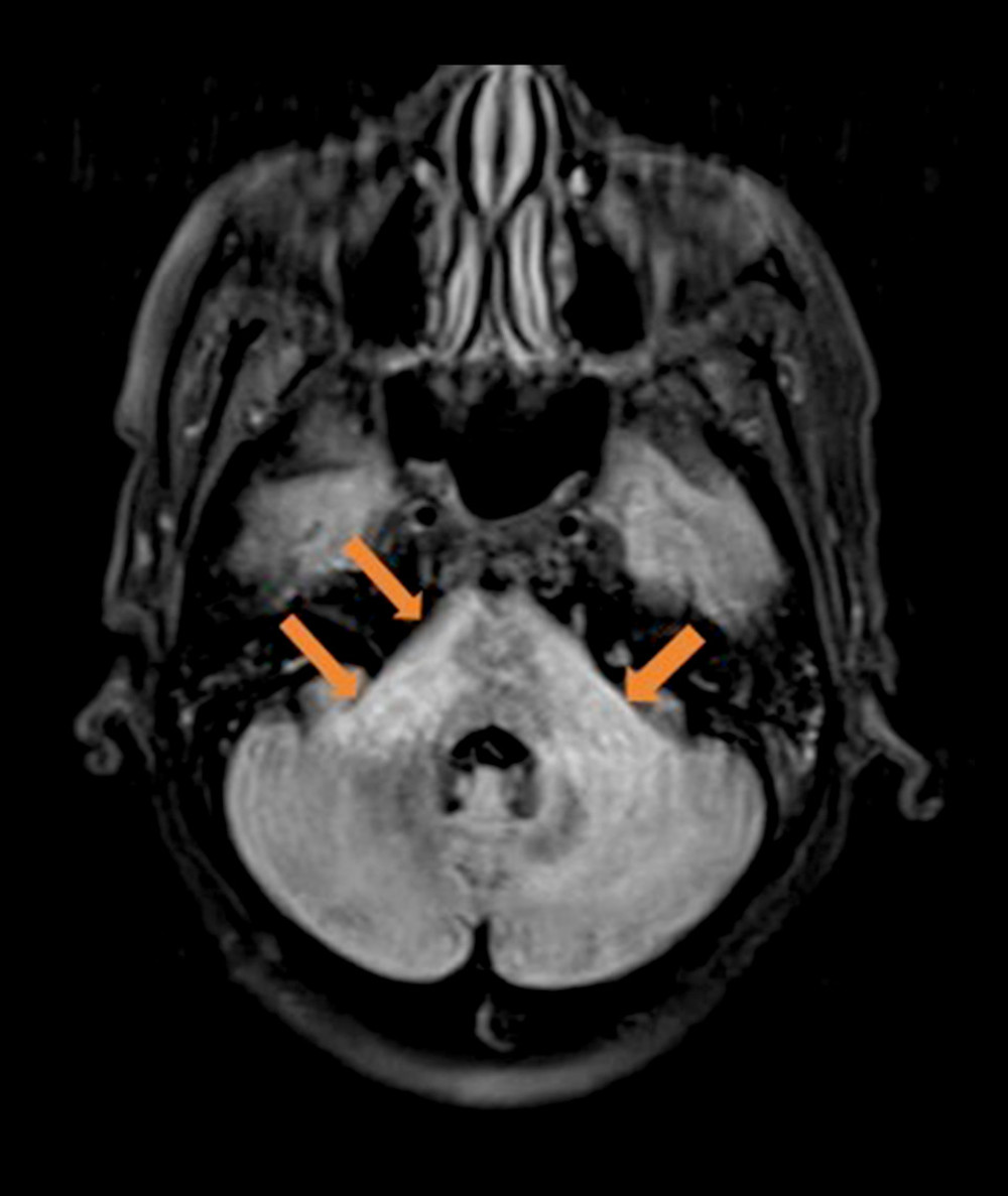 Brain magnetic resonance imaging (MRI), on the second emergency department visit (week 3), revealed non-enhancing patchy abnormal signals in the bilateral middle cerebellar peduncles, pons, and deep left cerebellar white matter. Thin rims along the superior and inferior floor of the fourth ventricle were also seen.