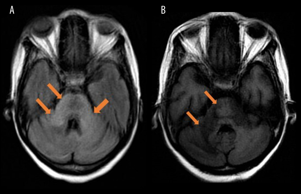 (A) Brain magnetic resonance imaging (MRI) on the second hospital admission (week 7) revealed non-enhancing confluent areas of abnormal T2-weighted signals in the bilateral middle cerebellar peduncle, pons, left>right cerebellar hemisphere, and right thalamocapsular and midbrain regions. (B) Brain MRI on the second hospital admission (week 7) showed corresponding non-enhancing T1-weighted hypointensities in the bilateral middle cerebellar peduncle, pons, left>right cerebellar hemisphere, and right thalamocapsular and midbrain regions.