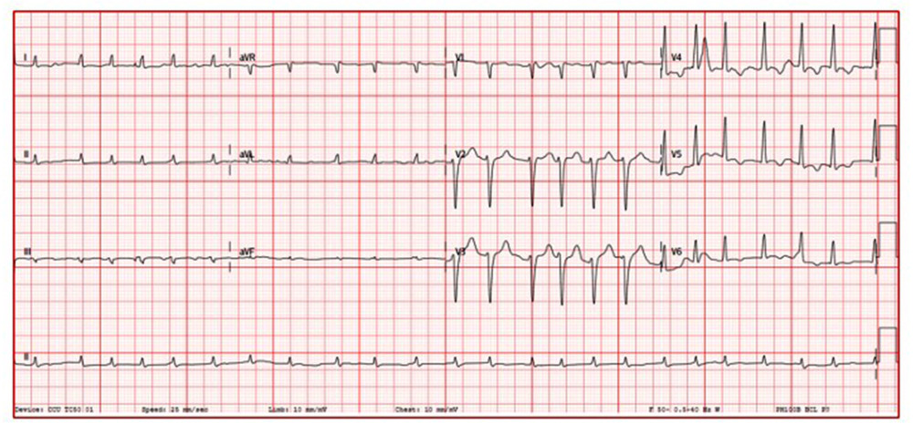 Electrocardiogram showing atrial fibrillation with rapid ventricular response, poor R-wave progression, and low voltage in the limb leads, with no specific ST and T wave abnormalities.