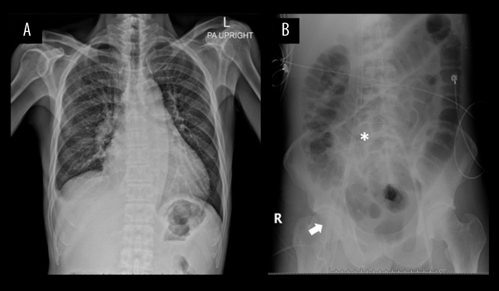 (A) Chest radiograph prior to ECMO showing cephalization (B) Abdominal X-ray showing inflow (asterixis) and outflow cannular (arrow) of the ECMO circuit in the inferior vena cava and the femoral artery, respectively.