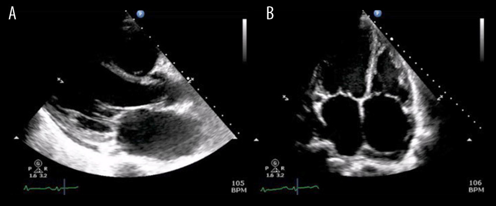 (A) Parasternal long-axis view of transthoracic echocardiography. (B) Four-chamber apical view of transthoracic echocardiography. Both show a dilated left ventricle with severely reduced systolic function and bilateral atrial enlargement.