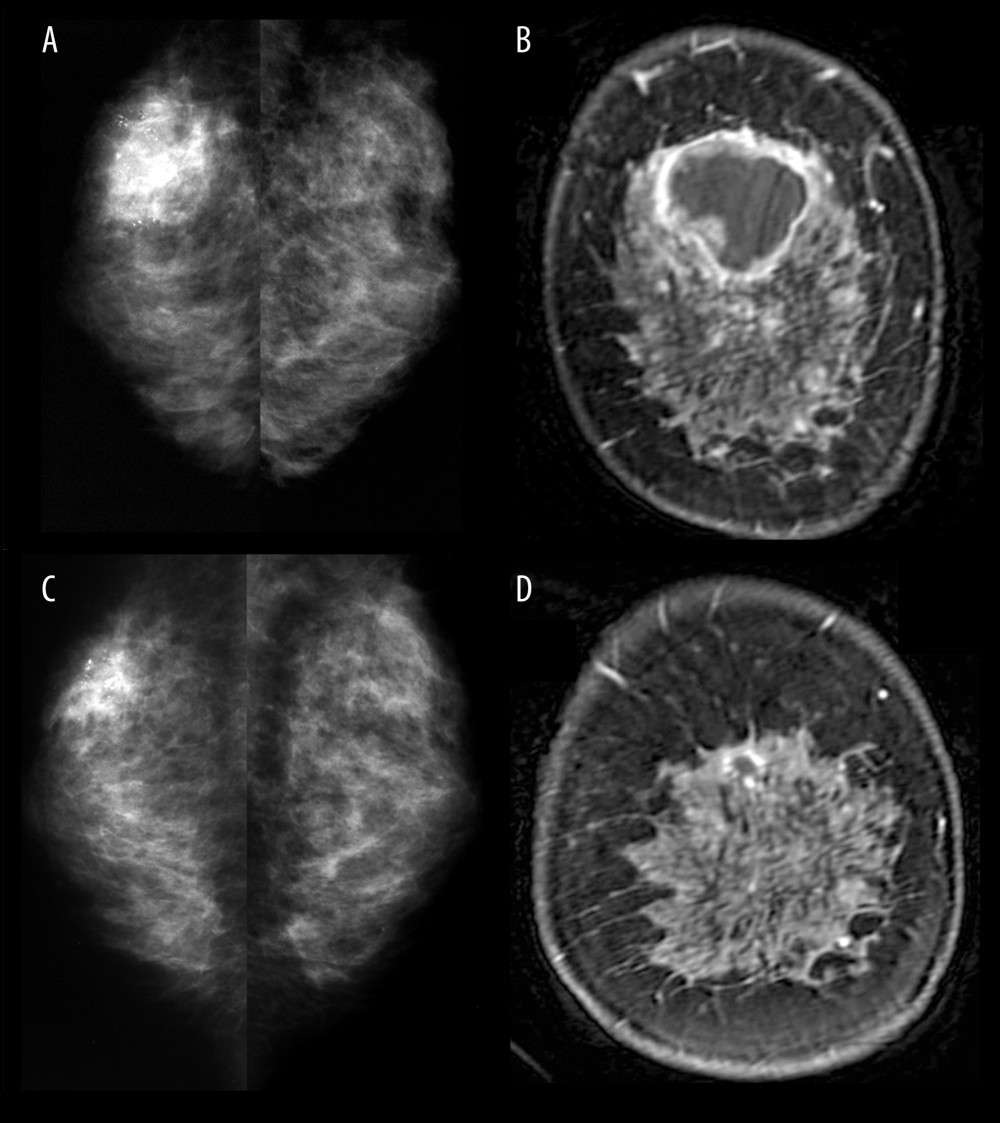 (A) Mammography performed before chemotherapy demonstrated an indistinct, high-density mass with pleomorphic calcification in the upper portion of the right breast. (B) Magnetic resonance imaging (MRI) before chemotherapy showed a lobulated mass with irregular margins and rapid enhancement during the early phase of the enhanced kinetics. The image demonstrated washout of the enhancement pattern during the delayed phase. (C) Mammography performed after chemotherapy showed the marked shrinkage of the mass with a microlobulated and partially irregular margin. (D) MRI after chemotherapy showed that the mass was considerably reduced.