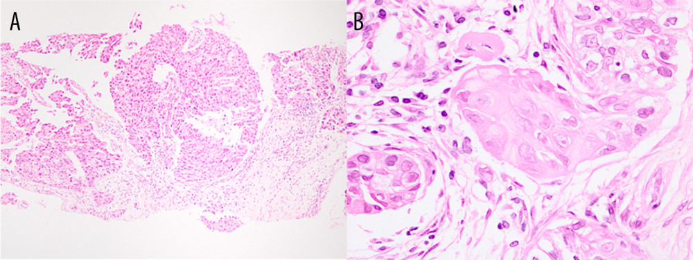 Core needle biopsy specimen of the tumor. (A) A low-power view showed squamous cell carcinoma (HE, ×100). (B) A high-power view showed a nest of squamous cell carcinoma (HE, ×400). HE, hematoxylin and eosin.
