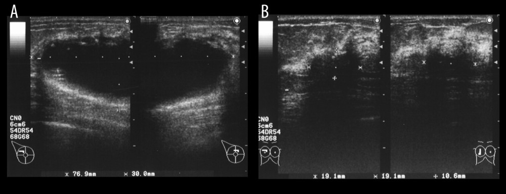 (A) Ultrasonography performed before the administration of weekly paclitaxel revealed a hypoechoic lesion with cystic components, measuring 7.7 cm. (B) Ultrasonography performed after chemotherapy showed that the size of the tumor was significantly decreased to 1.9 cm.