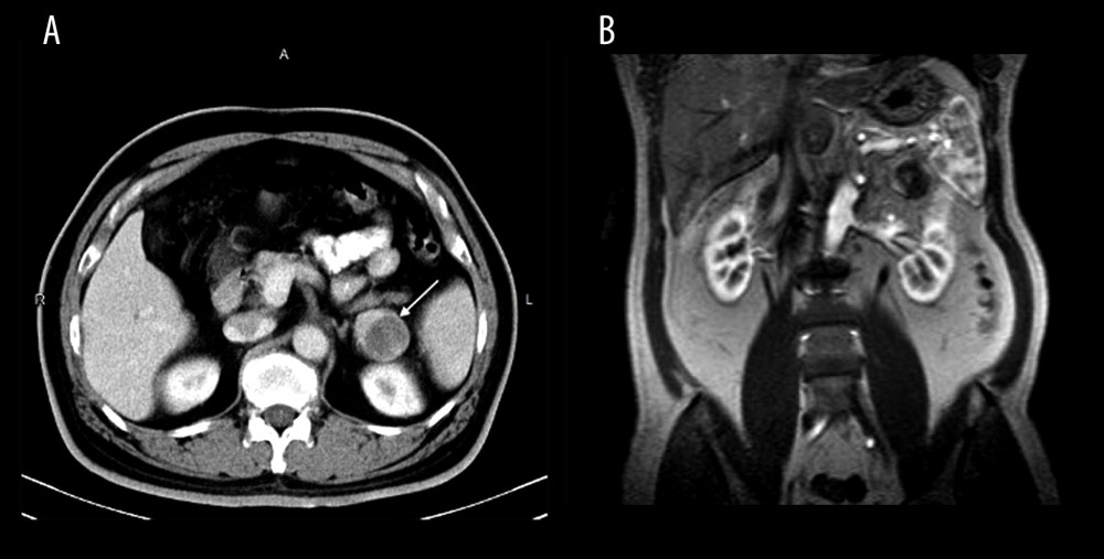 (A) The abdominal computed tomography scan shows a low-density lesion (white arrow) over the left adrenal gland with ring enhancement after contrast medium injection. (B) The initial T1 magnetic resonance image of the adrenal cyst reveals a well-defined, round nodular lesion, measuring 3.84 cm, over the left suprarenal region with 2 different signals on the T1 image. The central region shows a relatively high signal but no contrast medium enhancement. The peripheral part shows moderate contrast enhancement.