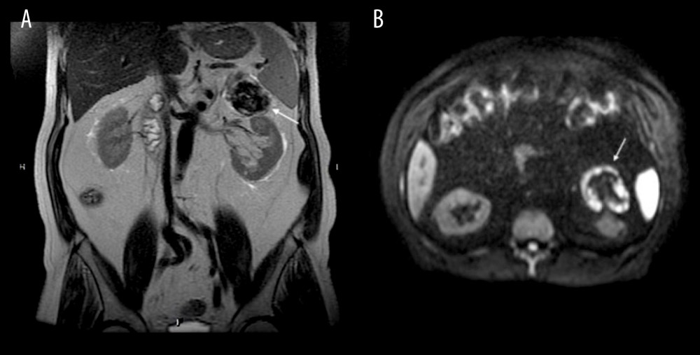 (A) A magnetic resonance image (15 years after initial MRI) of the adrenal cyst (white arrow) reveals an enlargement of the cyst (size, 6 cm). The central part of the tumor resembles a hematoma. (B) The dynamic contrast-enhanced MRI of the left adrenal tumor shows progressive enhancement in the peripheral part of the cyst (white arrow) with central hematoma formation.