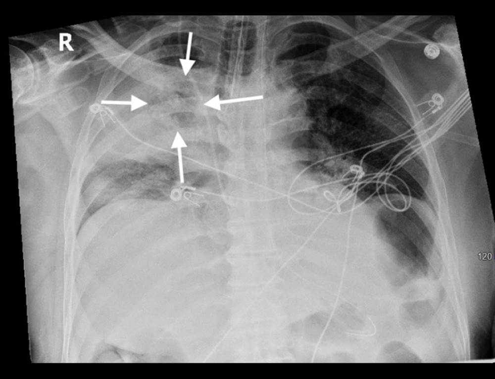 Chest X-ray on day 3 of admission. Arrows point to persistent right upper lobe consolidation.