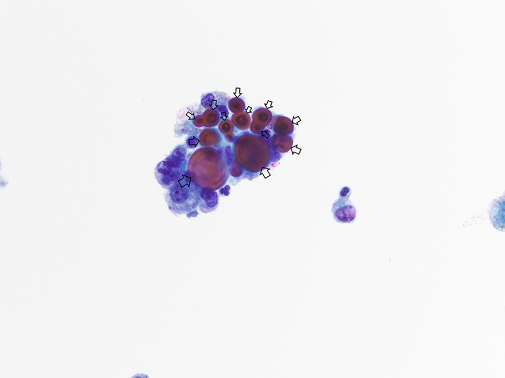 Papanicolaou stain that characterizes the broad-based budding fungus consistent with Blastomyces.