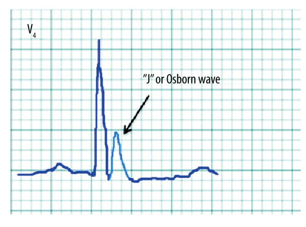 Osborn wave. Source: Chavez LO, Leon M, Einav S, Varon J, Editor’s Choice – Inside the cold heart: A review of therapeutic hypothermia cardioprotection. Eur Heart J Acute Cardiovasc Care. 2017;6(2):130–41, used with permission from Oxford University Press for the European Society of Cardiology.