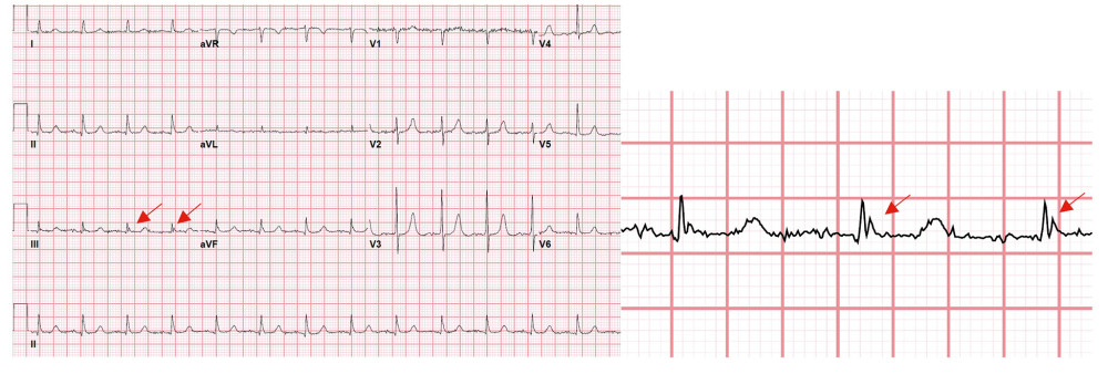 A 12-lead electrocardiogram obtained at core temperature of 34.7°C. Sinus rhythm with Osborn wave, an extra deflection at end of QRS complex on the lead III (arrow).