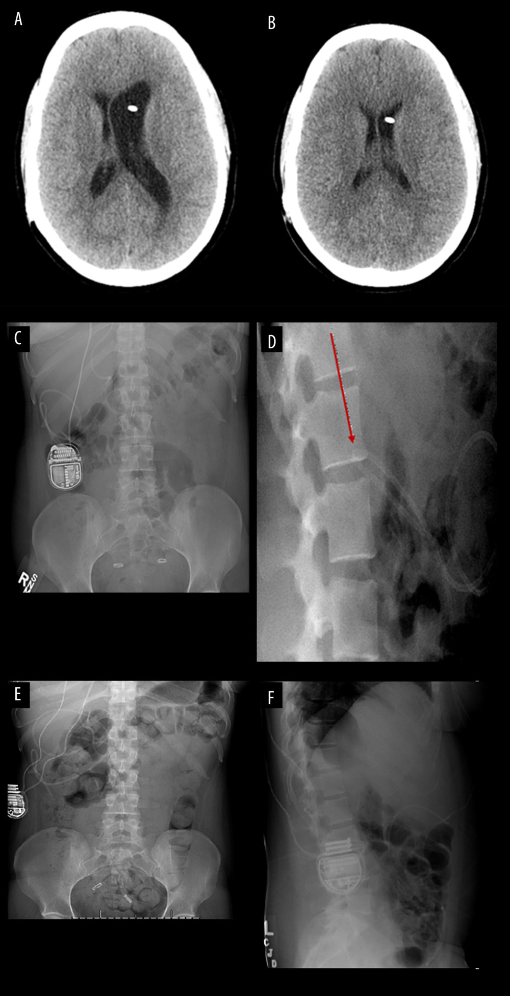Axial computed tomography (CT) scan depicting enlarged ventricles. (A) compared to prior CT scan (B) concerning for shunt failure. Anteroposterior (C) and lateral (D) shunt series X-rays demonstrating kinking of the distal peritoneal catheter (arrow) compared to postoperative anteroposterior (E) and lateral (F) shunt series X-rays following laparoscopic tubal ligation, without evidence of kinking at that time.