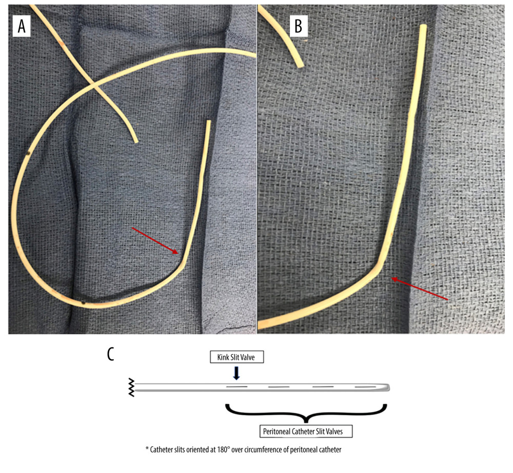 Intraoperative images (A, B) demonstrating kinking of the distal catheter at the site of the distal peritoneal slit valves (arrow). Illustration (C) depicting the location of the catheter kink in relation to the distal peritoneal slit valves.