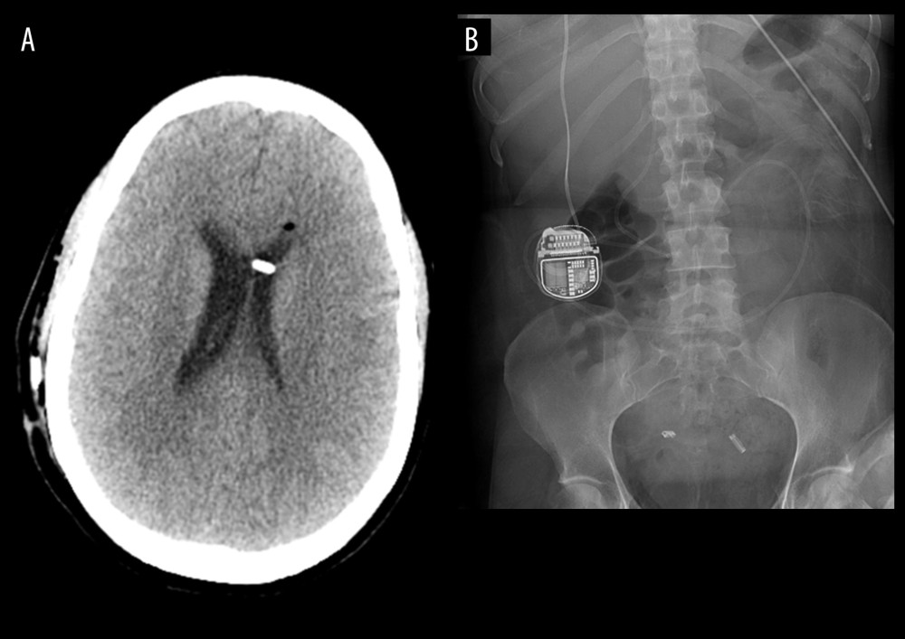 Axial postoperative computed tomography (CT) scan depicting interval decrease in the size of the ventricles (A). Shunt series X-rays demonstrating intact shunt system with no kinking or discontinuity (B).