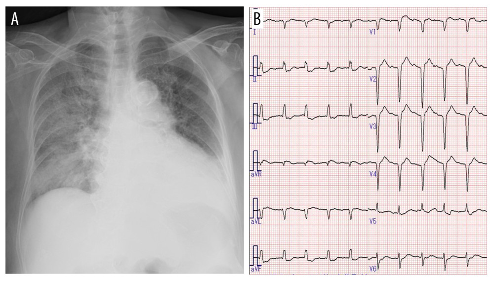 (A) Chest X-ray and (B) electrocardiogram on admission.