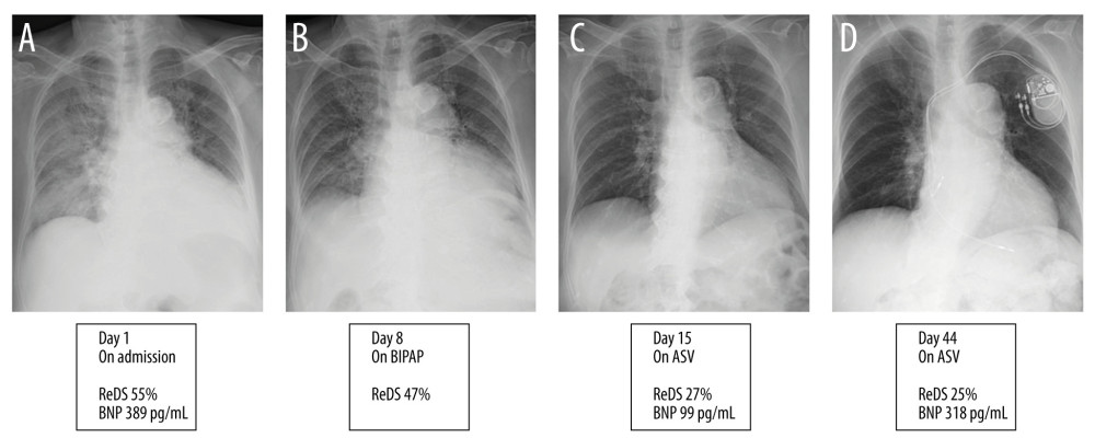 (A–D) Time course of chest X-ray and ReDS values. ReDS – remote dielectric sensing; BNP – B-type natriuretic peptide; ASV – adaptive servo-ventilation.