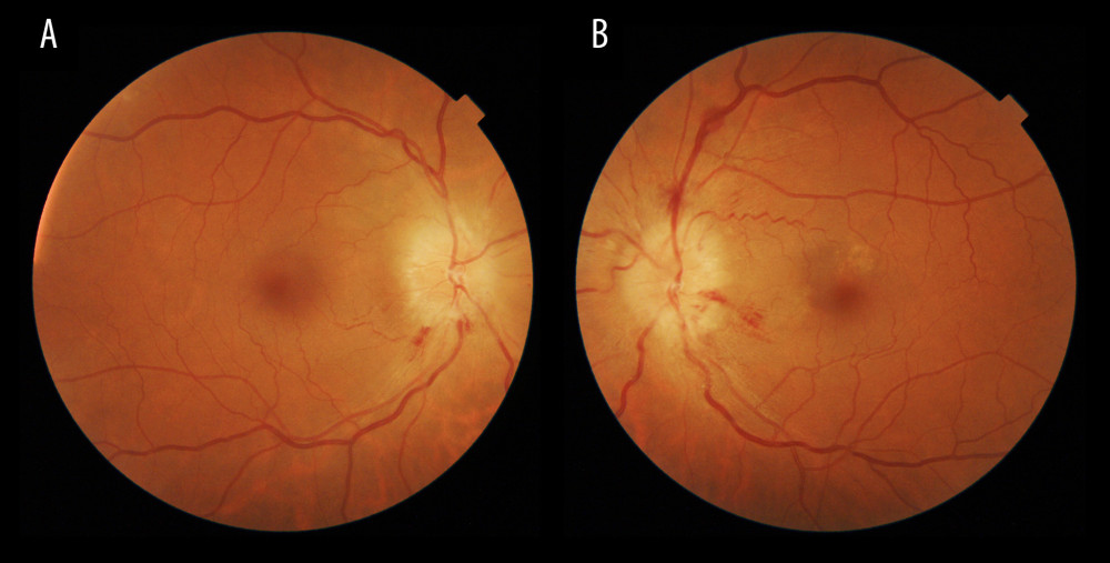 A and B are funduscopy images of the first case. Right and left eyes, respectively, illustrating optic disc swelling predominantly in the left eye with some hemorrhages at the critical moment.