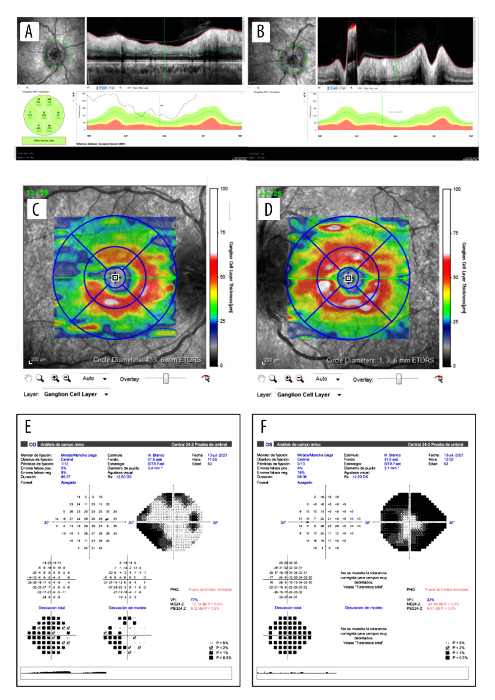 OCT images and their functional correspondence by Humphrey 24-2 visual field. A and B show the retinal nerve fiber layer (RNFL) thickness of the right and left eye, respectively. It was not possible to measure the edema in the left eye at the critical moment. C and D illustrate the ganglion cell layer thickness of the right and left eye, respectively, showing a loss in the superotemporal quadrant of the right eye 3 weeks after the initial symptoms. The left eye remains at normal levels. E and F show the Humphrey 24-2 visual field of the right and the left eye, respectively. The right eye shows a lower nasal scotoma, while the left eye shows a constriction of the visual field.