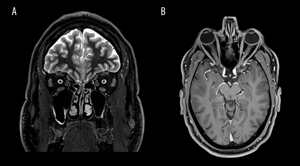 (A, B) Coronal and axial views of the brain on MRI, without any finding of neuritis.