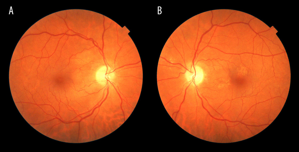 A and B are funduscopy images of the first case after 3 months of the event. Right and left eyes, respectively, illustrating pallor disc in both eyes, without any hemorrhages.