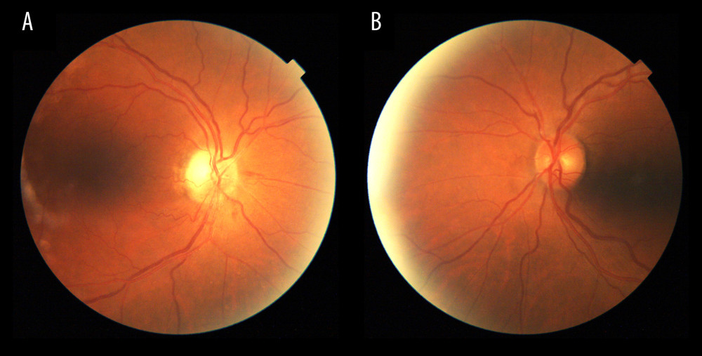 A and B show funduscopy images of the second case, right and left eye, respectively. A shows disc pallor in the superotemporal quadrants after a month of the critical moment and B illustrates no predisposing, axonal crowding in the disc of the left eye.