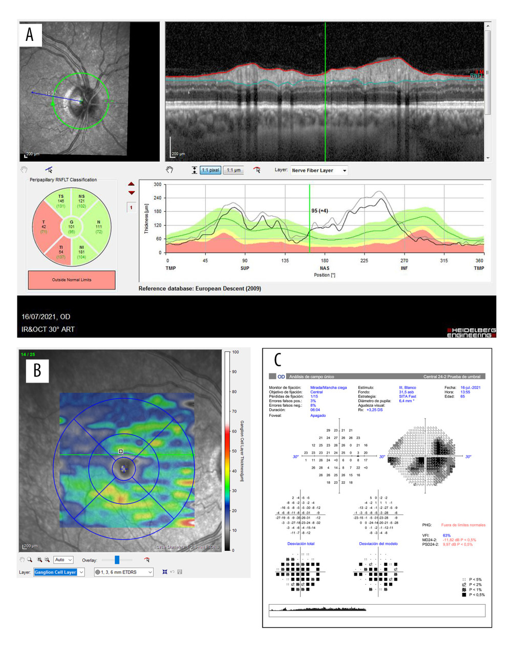 Evolution of the OCT and Humphrey 24-2 visual field in the second case. A shows the RNFL of the right eye and the correspondence of the atrophic quadrants in the affected eye after a month of the symptoms. B illustrates general loss of ganglion cells of the right eye. Image C illustrates the Humphrey 24-2 visual field of the right eye, showing a centrocecal scotoma.