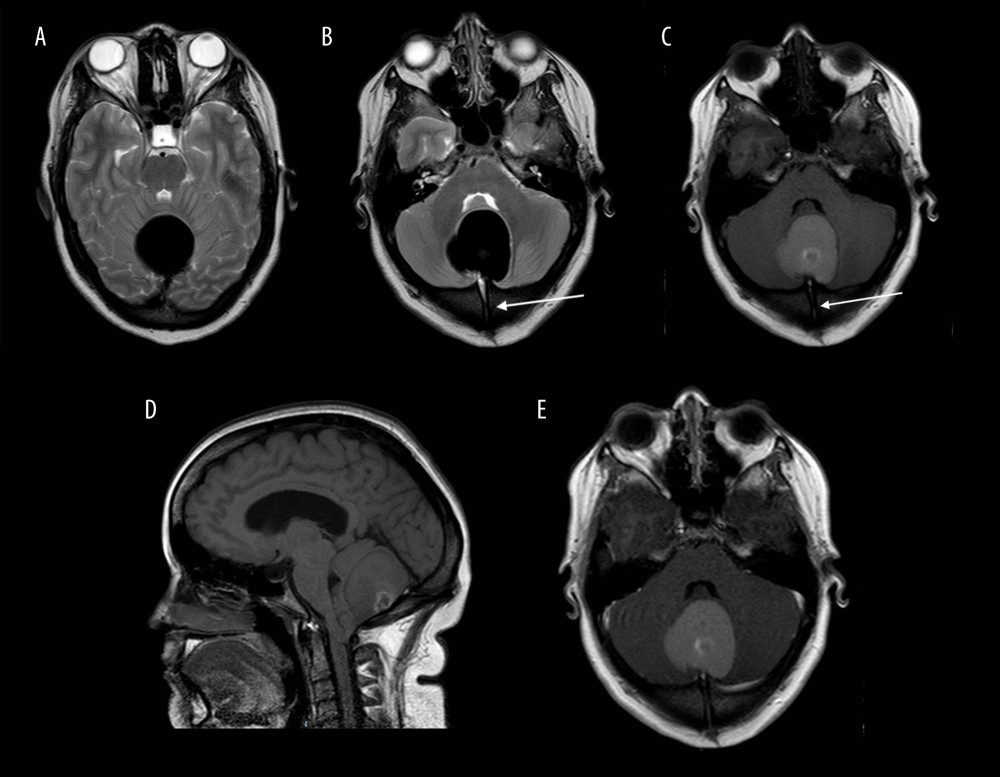 Brain MRI showing a well-circumscribed lesion at the midline posterior fossa, which is profusely hypointense on T2-weighted sequences and hyperintense on T1-weighted sequences, without frank contrast enhancement. A transdiploic channel (arrow) is seen. There is associated mild supratentorial obstructive hydrocephalus. (A, B) T2-weighted axial images, (C) T1-weighted axial image, (D) T1-weighted sagittal image, (E) T1-weighted post-contrast axial image.