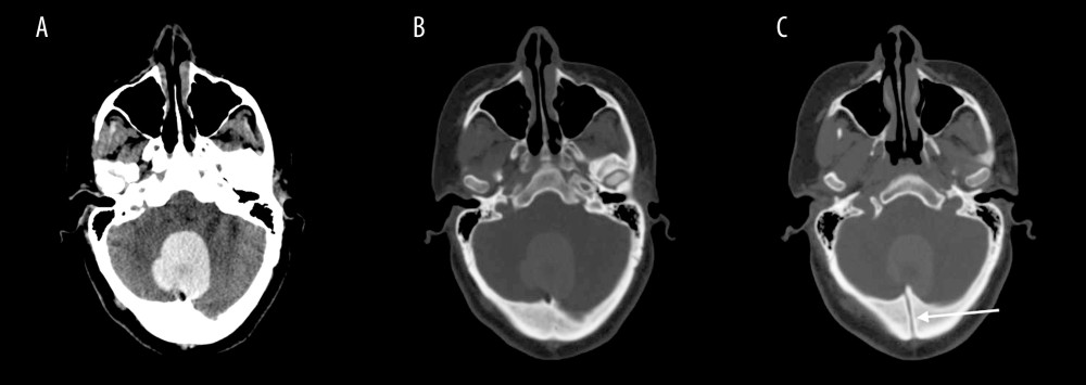 Head CT scan without contrast administration showing a midline posterior fossa homogenously hyperdense lesion with an overlying transdiploic channel (arrow). (A) Brain window CT axial image, (B, C) bone window CT axial images.