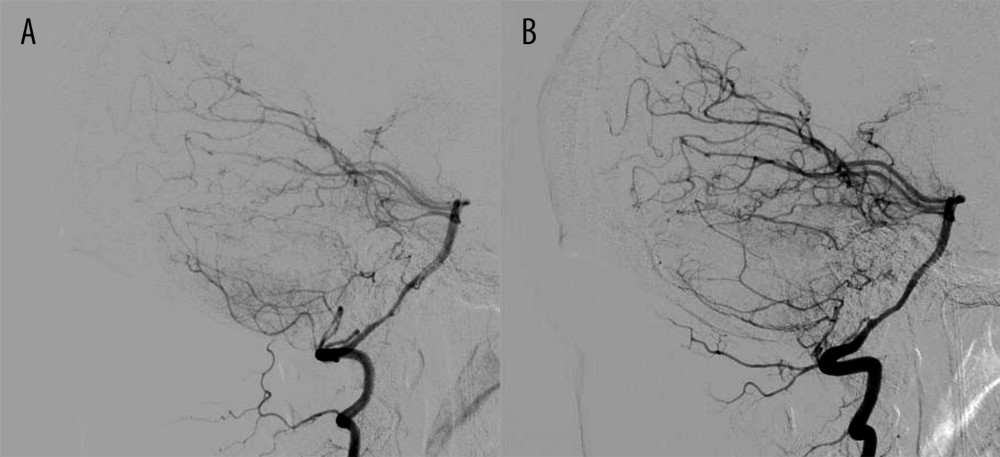 Digital subtraction angiography (DSA) images of the posterior circulation showing no evidence of a vascular lesion or of neoplastic/tumoral blush. There is inferior displacement of the left posterior inferior cerebellar artery. (A) Right vertebral artery injection, (B) left vertebral artery injection.