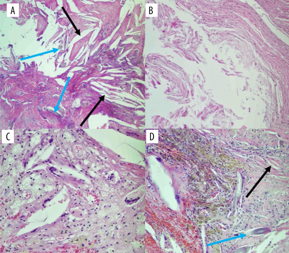 Hematoxylin and eosin stains with (A) 40×, (B, D) 100×, and (C) 200× magnification showing cholesterol clefts (black arrows) and hair shafts (blue arrows), as well as luminal lamellated keratin flakes. Additionally, foreign-body type (multinucleated) giant cell reaction (C) and pigment-laden macrophages are shown (D).