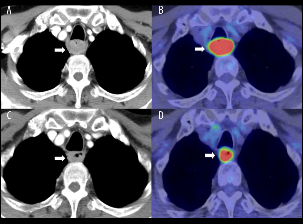 (A) Thoracic and abdominal contrast-enhanced computed tomography (CT) before neoadjuvant chemotherapy (NAC). Tumor is indicated by arrows. (B) Fluorine-18-deoxyglucose (FDG) accumulation was 22.33 times the standard uptake value on positron emission tomography (PET)-CT before NAC. Tumor is indicated by arrows. (C) Thoracic and abdominal contrast-enhanced CT after NAC showing a marked reduction in the size of the esophageal lesion. Tumor accumulation is indicated by arrows. (D) FDG accumulation decreased to 18.69 on PET-CT after NAC. Tumor accumulation is indicated by arrows.