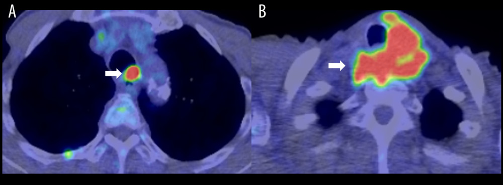 (A) Fluorine-18-deoxyglucose (FDG) accumulation at the esophageal anastomosis (19.67). Tumor accumulation is indicated by arrows. (B) FDG accumulation at the cervical lymph nodes. Tumor accumulation is indicated by arrows.