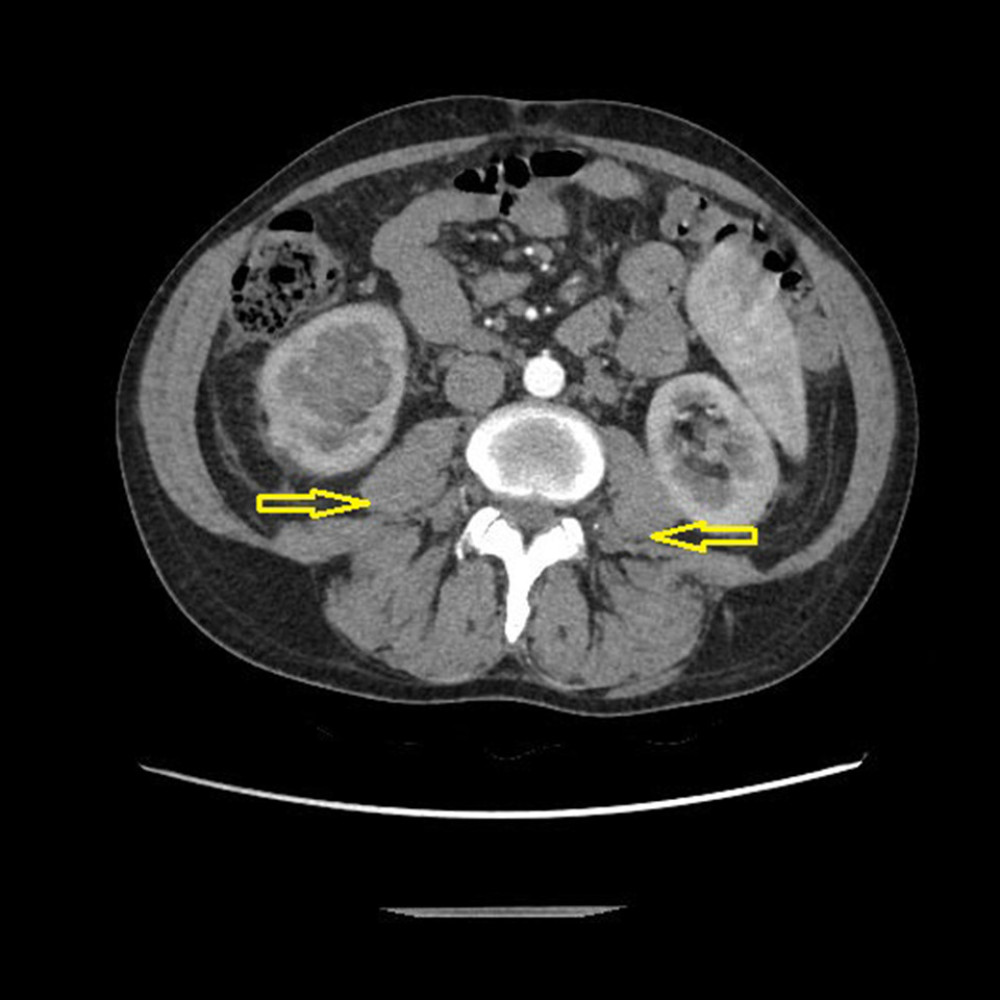 CT scan with abnormal masses (arrows indicate pathological masses).