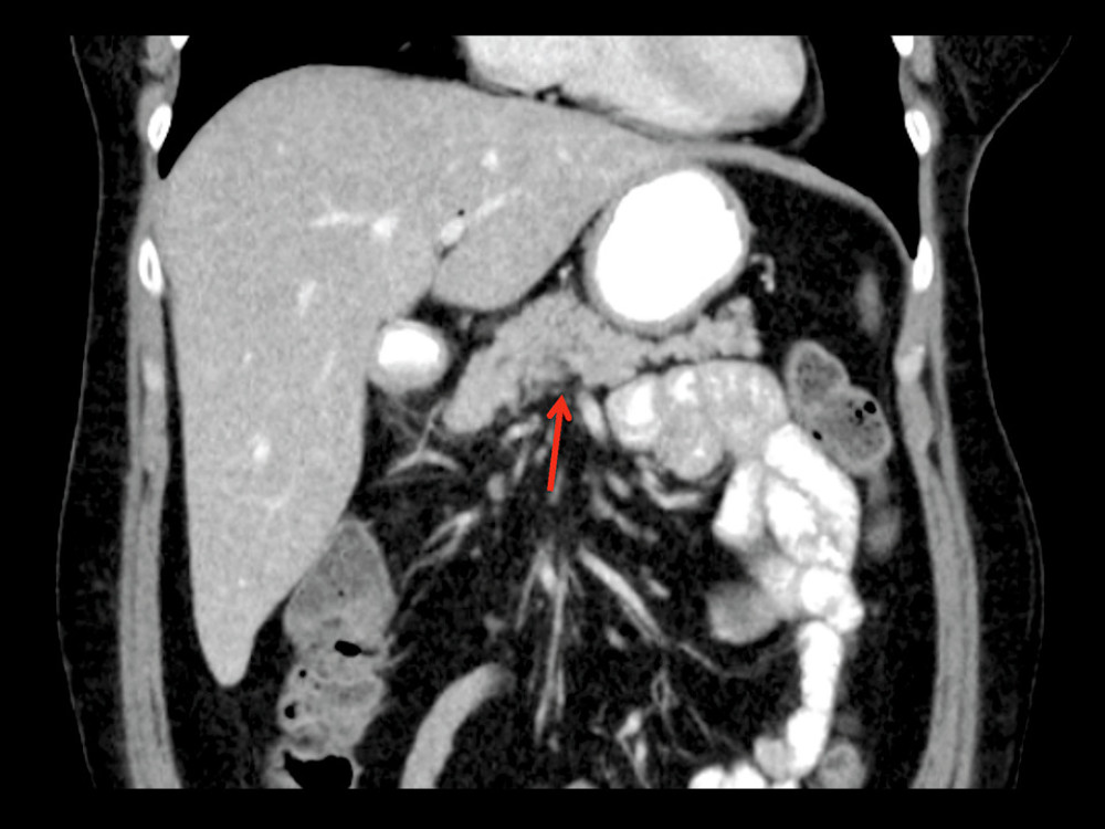 Computed tomography picture of the abdomen with an arrow pointing to the pancreas. Scan indicates pancreatic atrophy without ductal dilation or major calcifications.