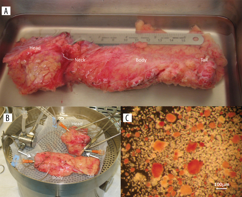 Excised pancreas during isolation and resulting islets. (A) Excised chronic pancreatitis pancreas cleaned of extraneous fat and tissue. The head, neck, body, and tail are labeled. (B) The pancreas head and body bisected at the neck with 14G catheters secured in the pancreatic ducts during perfusion with collagenase using a Rajotte controlled-temperature recirculation device. The head, body, and tail are labeled. Arrows are pointing to the bisected planes of the neck. (C) Sample of final islet cell mass of 30 to 40% purity. Islets are stained red with dithizone. Acinar tissue does not take up dithizone and is pale in color. Scale bar=100 µm.