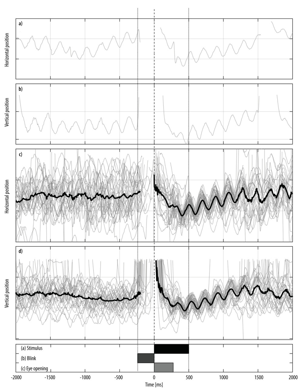 Video-oculography findings of the right eye during the first session (before beginning with memantine); the x-axis represents time in milliseconds and the y-axis represents the eye position; a) Horizontal component of the pendular nystagmus in the right eye in one trial while examining the visual acuity before and after stimulus; b) Vertical component of the same trial; c) Horizontal component of the pendular nystagmus in the right eye in all 32 trials (superimposed grey lines) with a black line indicating the mean horizontal component of the APN; d) Corresponding vertical eye movements. Vertical dashed line represents the end of the blink preceded by the lightly shaded bar reflecting the period of the blink. The period during which the visual acuity stimulus was presented is indicated by the black bar. Note the suppression of the nystagmus and the consistent resetting of the phase of the oscillations with blinks (c, second column).