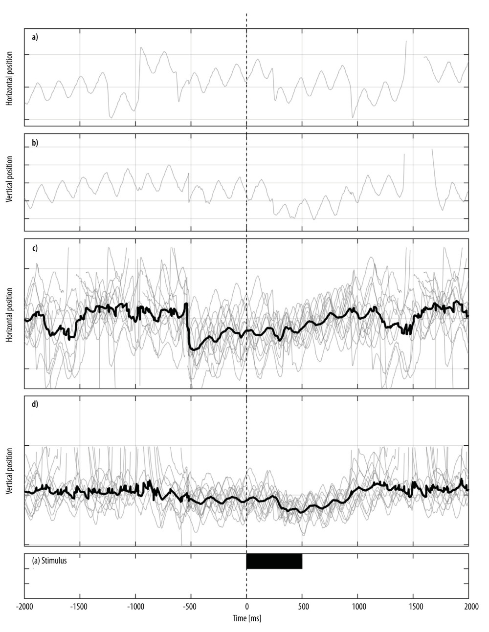 Video-oculography findings of the right eye during the first session (before beginning with memantine); the x-axis represents time in milliseconds and the y-axis represents the eye position; a) Horizontal component of the pendular nystagmus in the right eye in one trial while examining the visual acuity before and after blinking; b) Vertical component of the same trial; c) Horizontal component of the pendular nystagmus in the right eye in all 32 trials (superimposed grey lines) with a black line indicating the mean horizontal component of the APN; d) Corresponding vertical eye movements. Vertical dashed line represents the begin of the stimulus. The period during which the visual acuity stimulus was presented is indicated by the black bar.