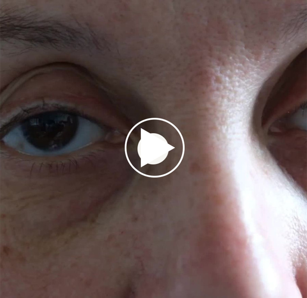 Binocular asymmetrical horizontal acquired pendular nystagmus most visible in the right eye. Notice the decrease of the nystagmus intensity after a blink of the right eye.